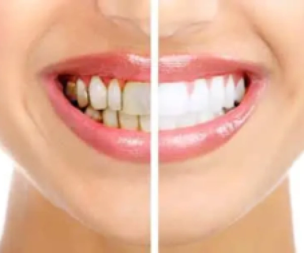 Healthy-beautiful-smile.-Dental-health.-Whitening-300x189