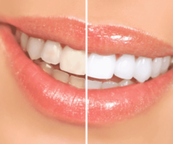 Teeth-Whitening-300x215
