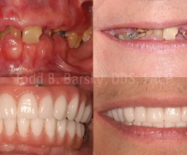 all-on-4-dental-implants-before-after-300x167