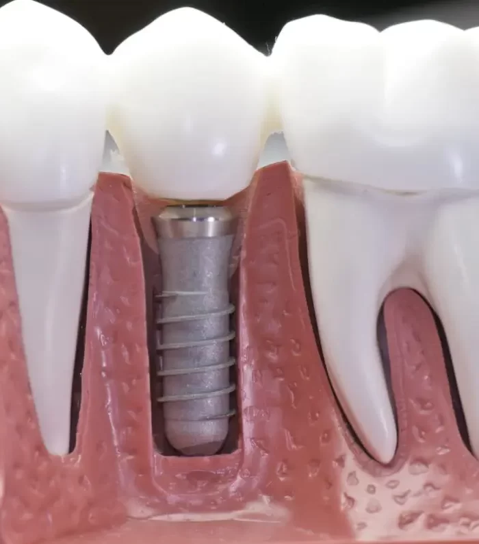 dental implants