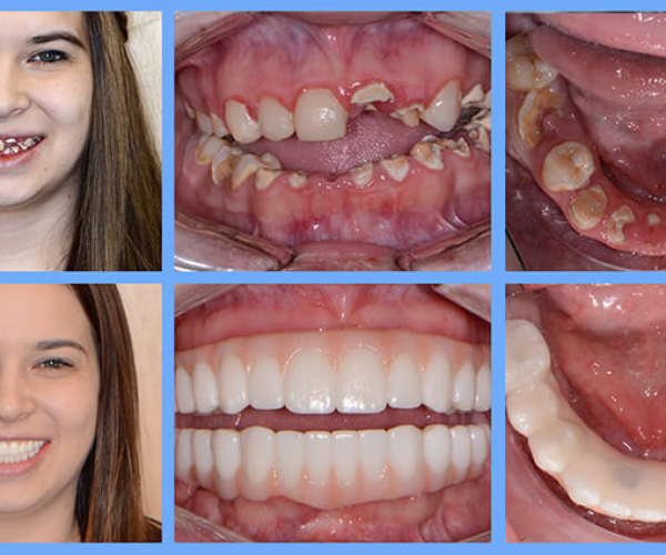 dental-implants-before-and-after-photo-1