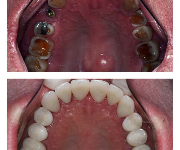 dental implants by Green Dental